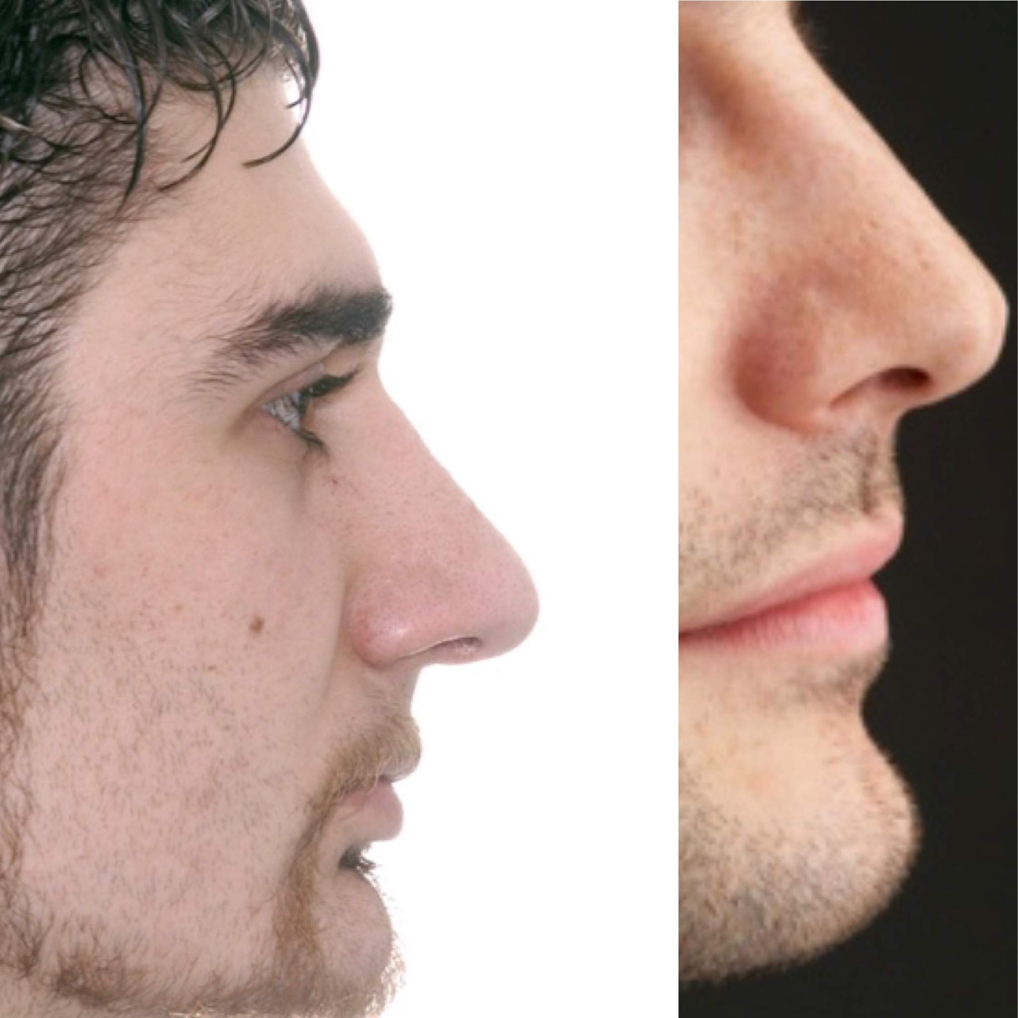 Nase verkleinern lassen als Junge? (Gesundheit und Medizin, Männer, Beauty)