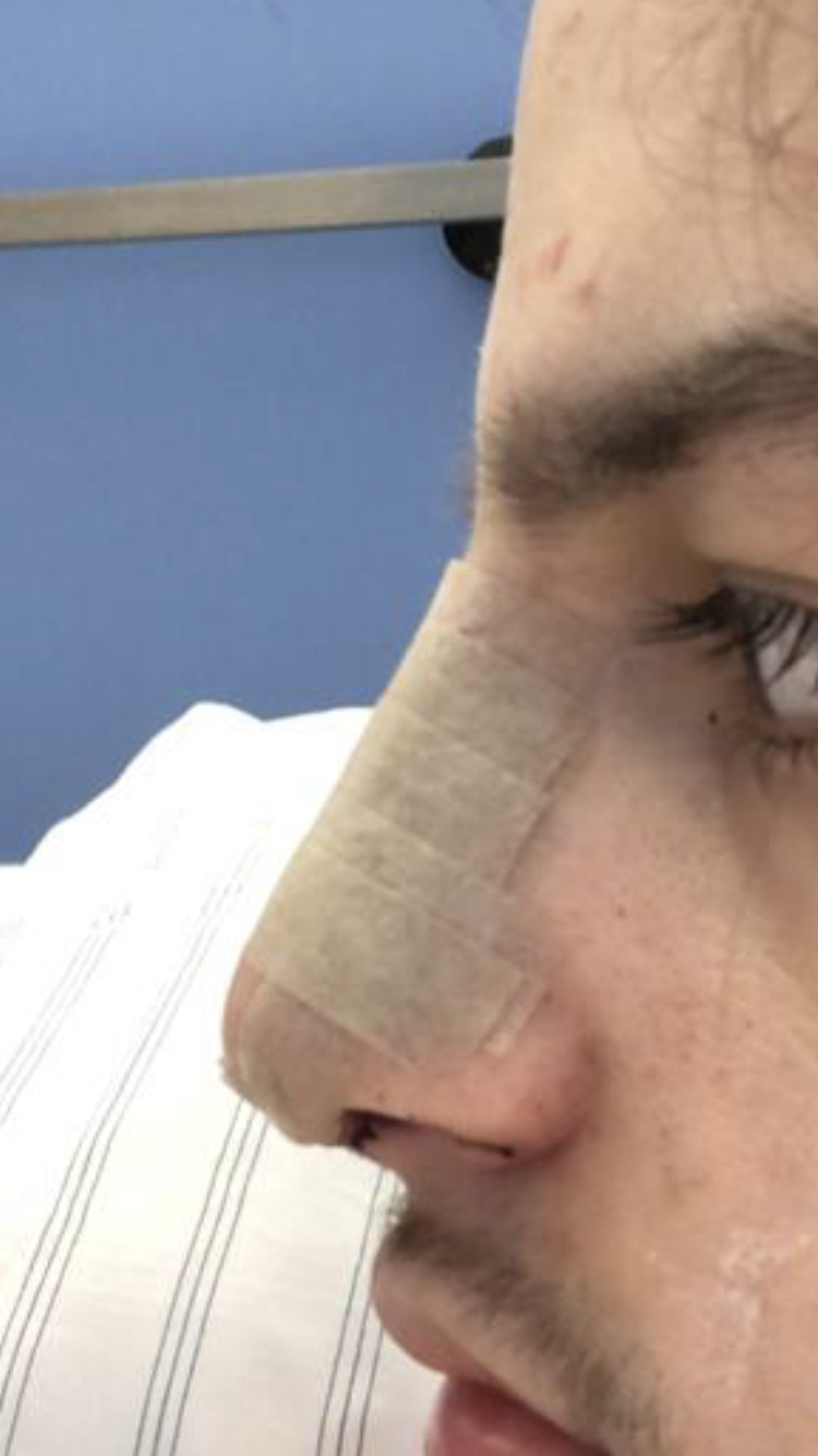 Nasen Op Gesundheit Und Medizin Nasen Op Nasen Op Gesundheit Und Medizin Nasen Op