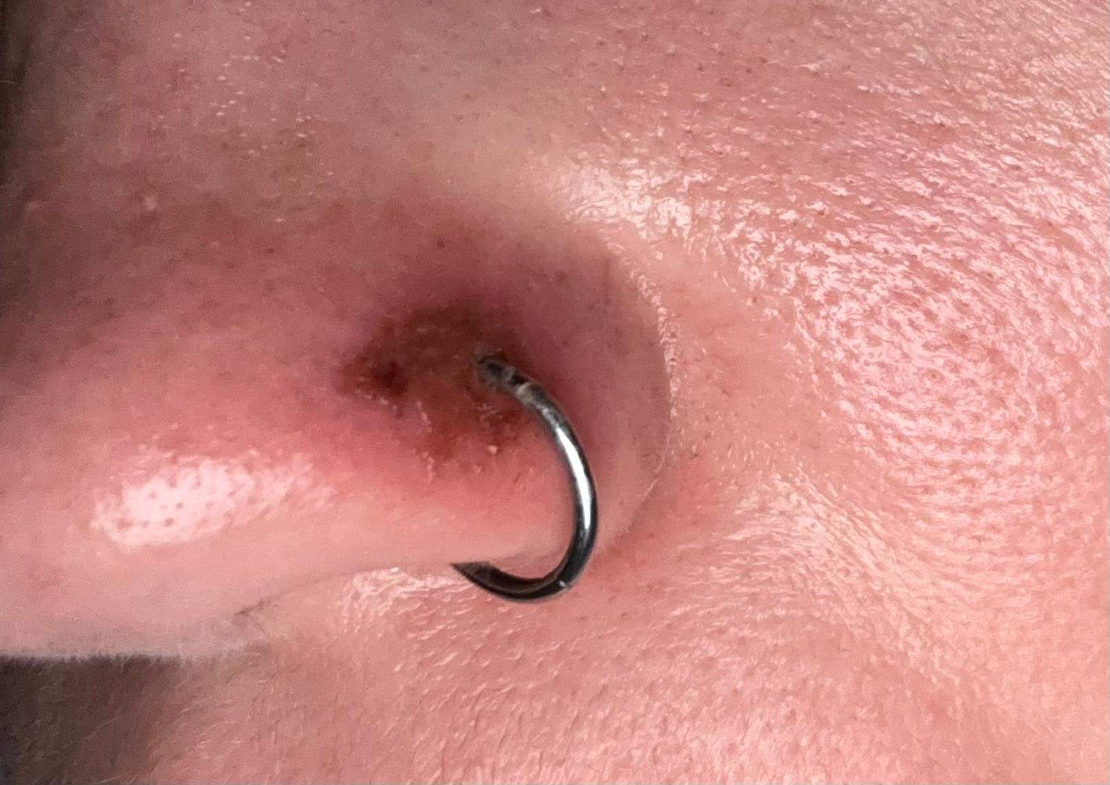 Nasenpiercing tut weh und Eiter kommt raus was soll ich tun will denn