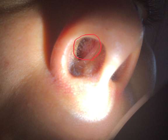 Nasenwunde Heilt Nicht Gesundheit Und Medizin Wunde Nasenscheidewand Nasenwunde Heilt Nicht Gesundheit Und Medizin Wunde Nasenscheidewand