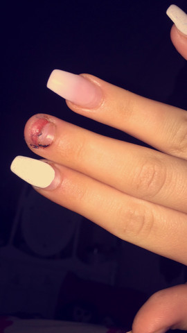 Naturnagel Abgerissen Was Nun Arzt Gelnagel