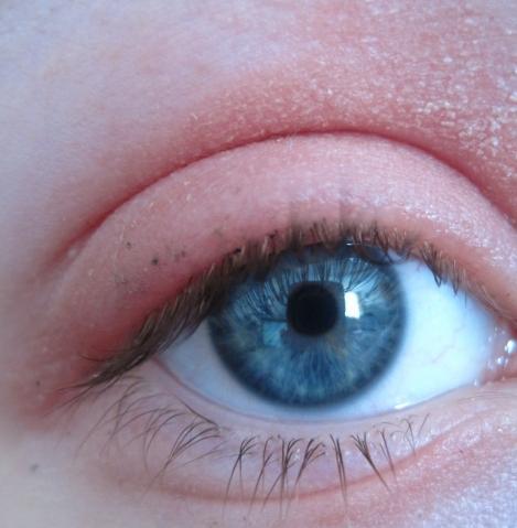So sieht die trockene Haut aus - (Augen, Neurodermitis, Augenlid)