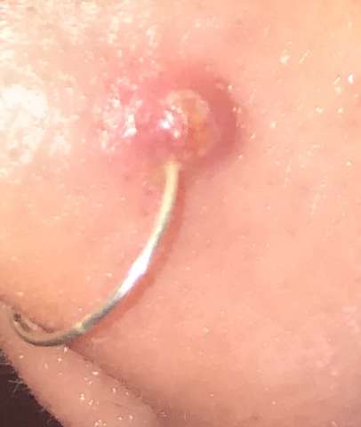 Neben Nasenpiercing Eine Sehr Grosse Blase Was Tun Schmerzen Piercing Eiter