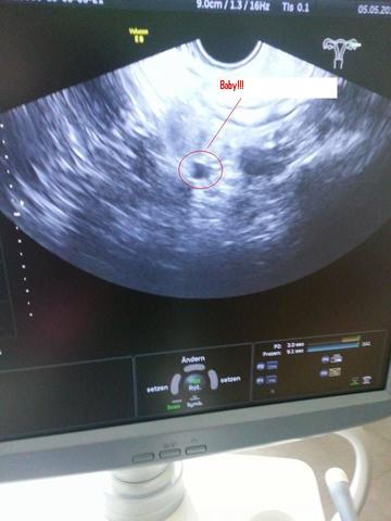 Ultraschall Bild vom 2ten Arzt!!! - (Schwangerschaft, schwanger, Frauenarzt)