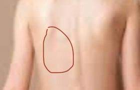 Nerv Eingeklemmt Gesundheit Und Medizin Nerven Nerv Eingeklemmt Gesundheit Und Medizin Nerven