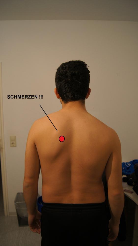 Nerv eingeklemmt! Rücken Schieflage! Schmerzen! (Gesundheit, Nerven