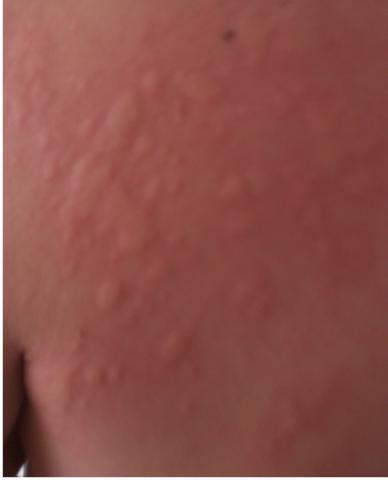 Nesselsucht Abwarten Oder Zum Arzt Krankheit Haut Nesselsucht Abwarten Oder Zum Arzt Krankheit Haut