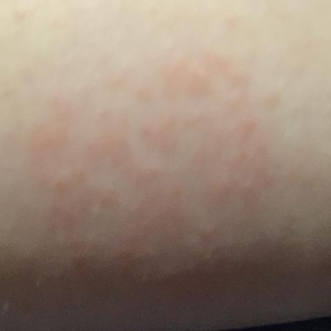 Unterarm Unterseite - (Juckreiz, Ausschlag, Herpes)