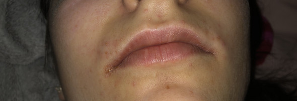 Nesselsucht Periorale Dermatitis Haut Mund Nesselsucht Periorale Dermatitis Haut Mund