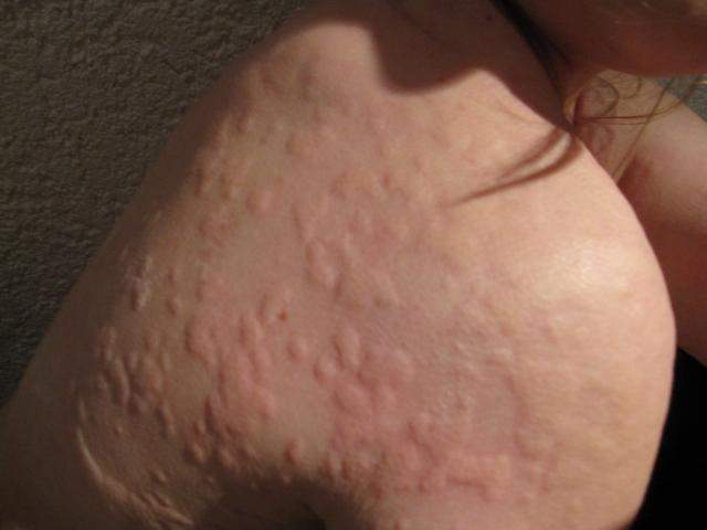 Nesselsucht Urtikaria Durch Die Schwangerschaft Gesundheit Medizin Allergie Nesselsucht Urtikaria Durch Die Schwangerschaft Gesundheit Medizin Allergie