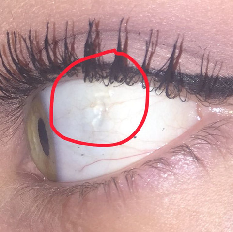 Netzhaut Lost Sich Ab Augen Gesicht Augapfel Netzhaut Lost Sich Ab Augen Gesicht Augapfel
