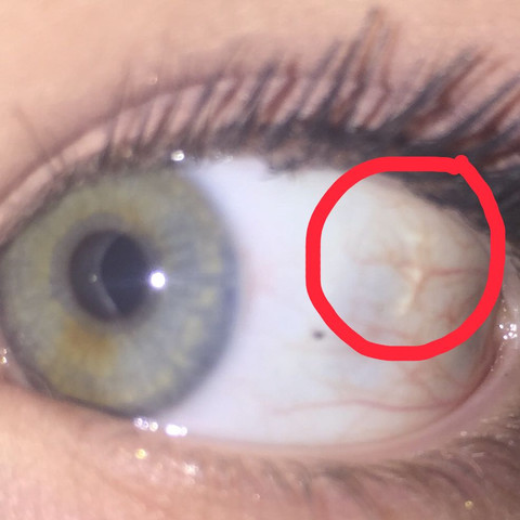 Netzhaut Lost Sich Ab Augen Gesicht Augapfel Netzhaut Lost Sich Ab Augen Gesicht Augapfel