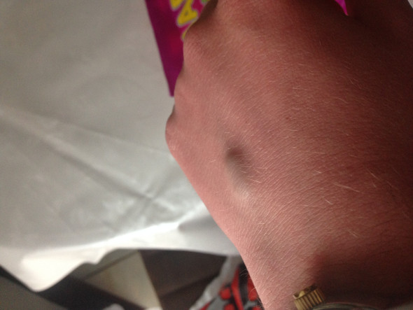 Neu Geplatzte Ader An Der Hand Was Tun Gesundheit Medizin Neu Geplatzte Ader An Der Hand Was Tun Gesundheit Medizin