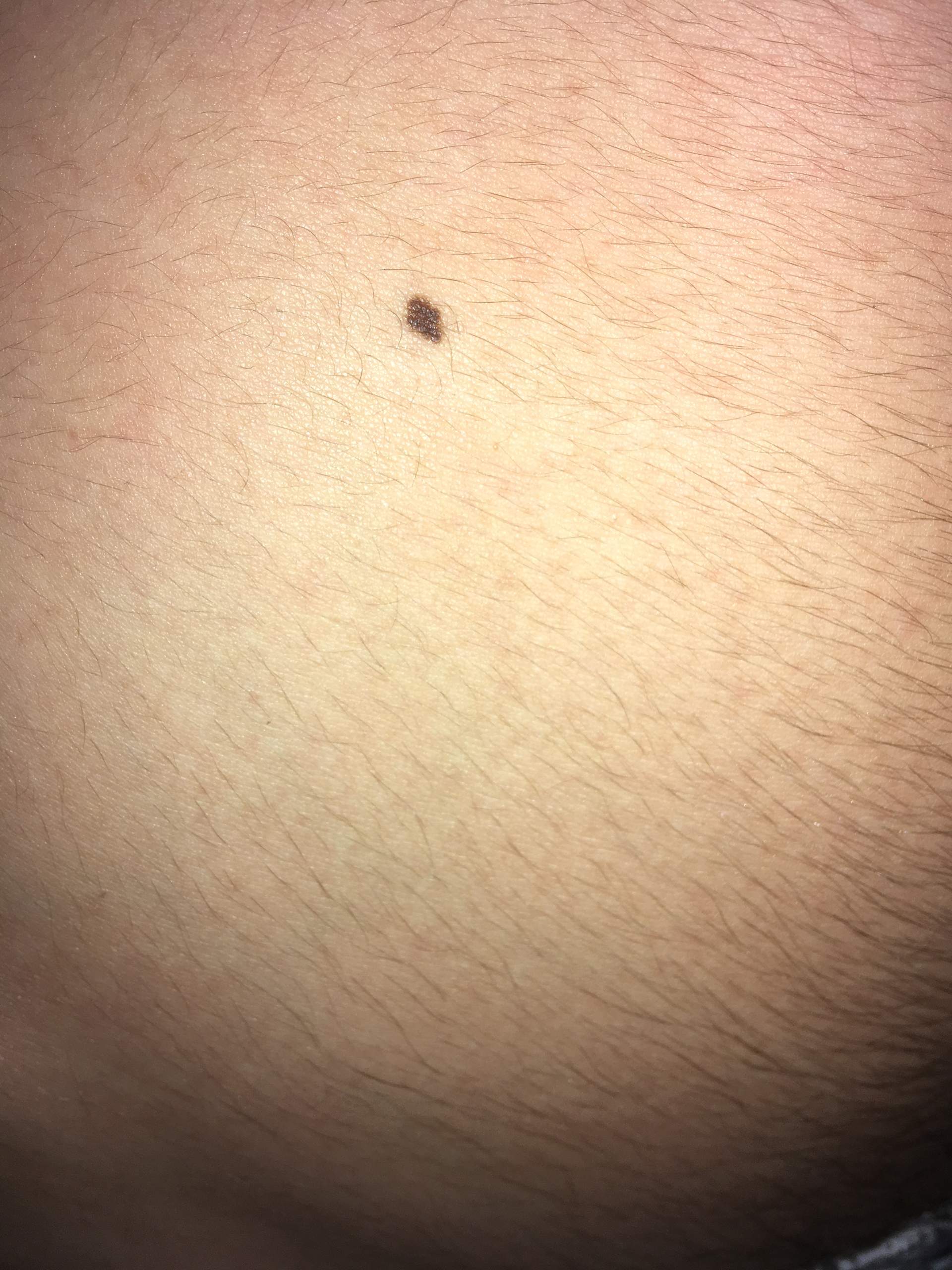 Neuer Leberfleck , was denkt ihr (Foto)? (Gesundheit, Medizin, Körper)