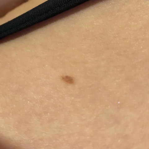 Neuer Leberfleck, gefährlich? (Gesundheit und Medizin, Medizin, Körper)