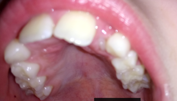 Zahn - (Zähne, wachsen)