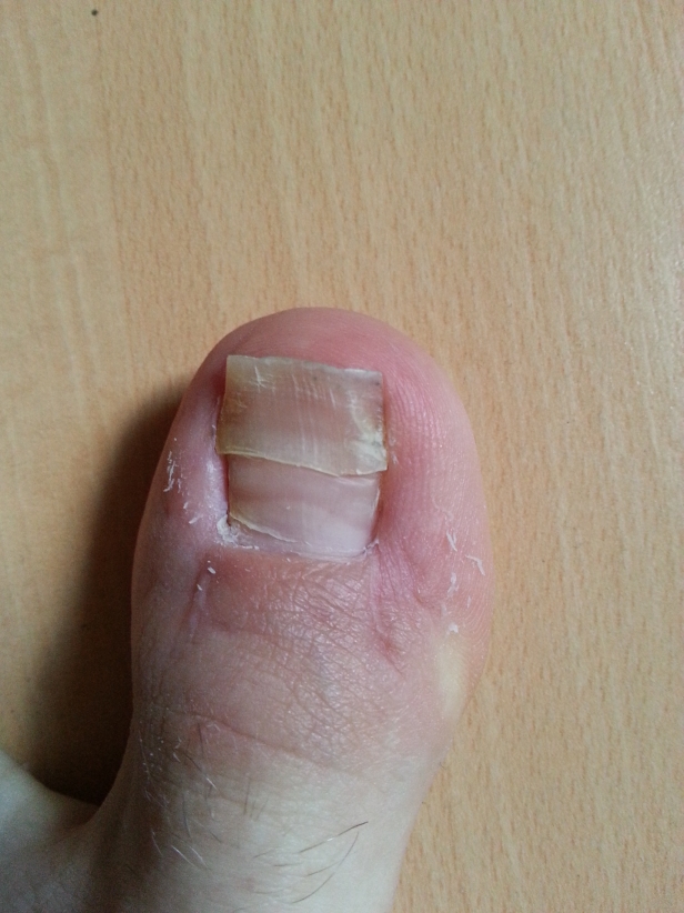 Neuer Zehnagel wächst obwohl der alte  Neuer Zehnagel wächst obwohl der alte