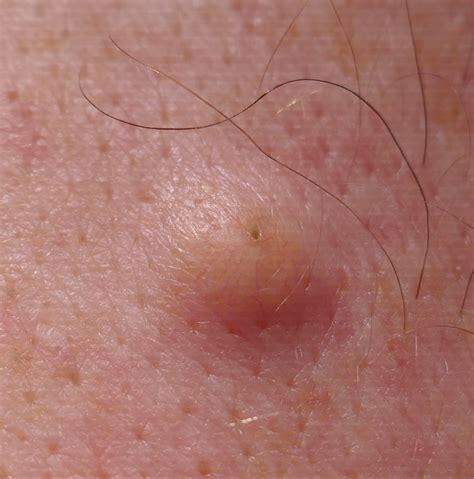 Neues Ei aufgetaucht neben den Hodensack? (Gesundheit und Medizin, Hoden, hodenschmerzen)