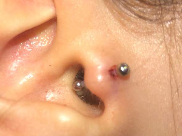 neues piercing entzundet oder nicht gesundheit und medizin ohr tragus piercing