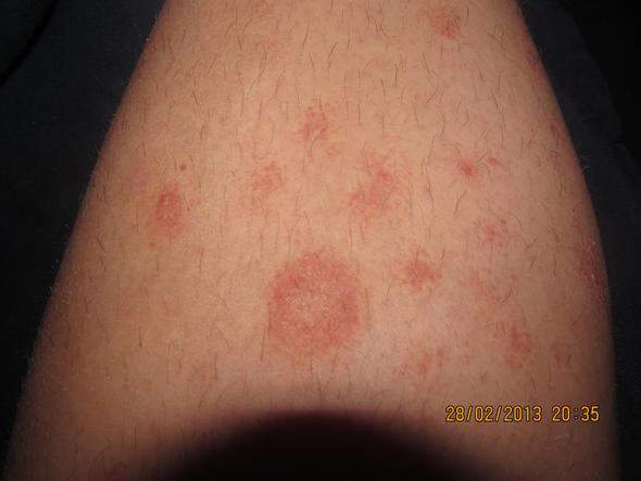 Neurodamitis oder krätze ich hab keine ahnung? :S (Krankheit, Haut