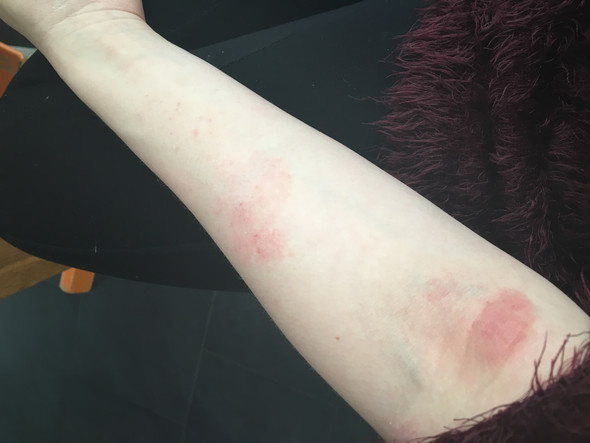 Neurodermitis Durch Katzenallergie Bedingt Hilft Eine Bioresonaz Neurodermitis Durch Katzenallergie Bedingt Hilft Eine Bioresonaz