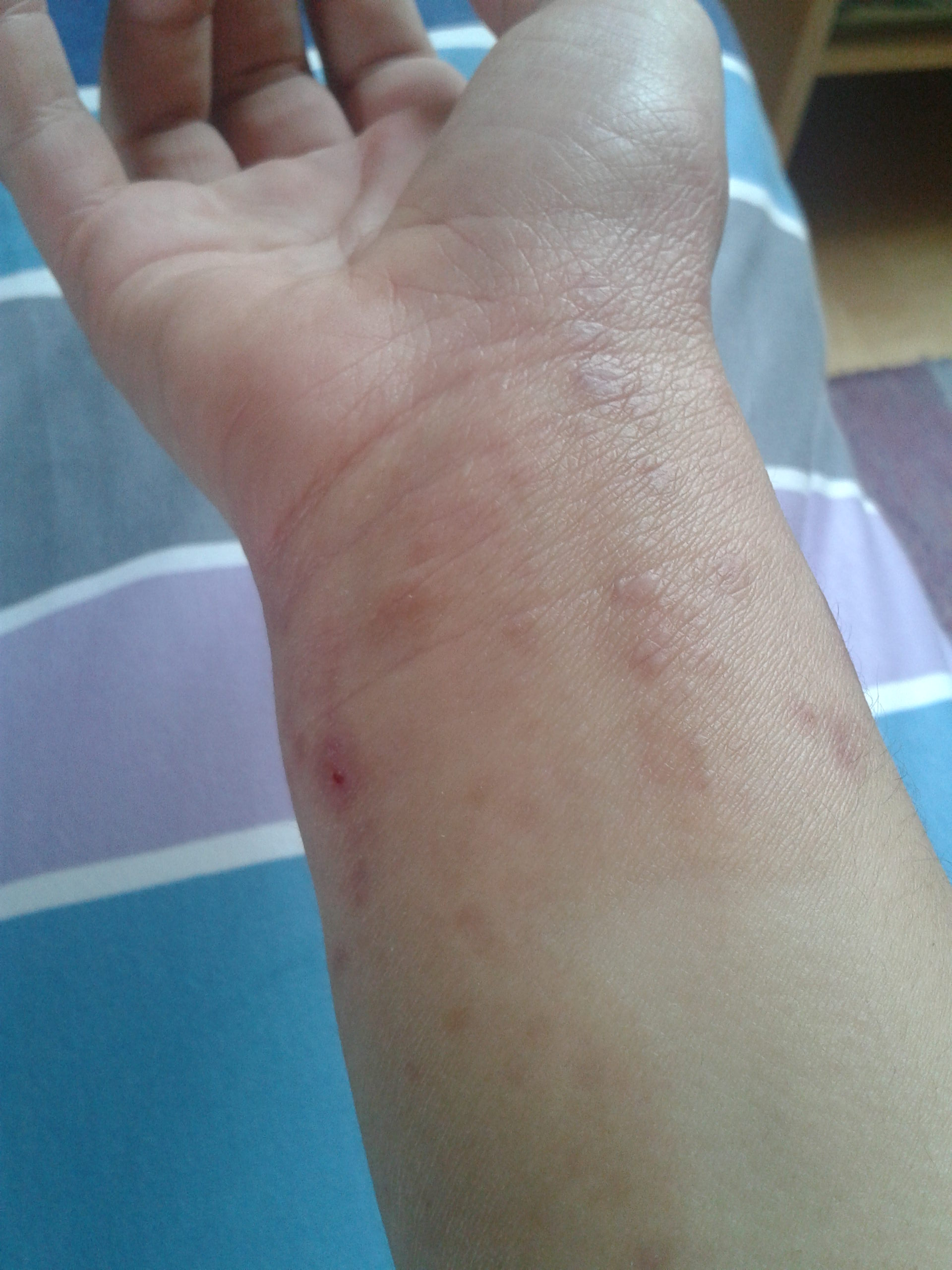 Neurodermitis, “Kratzsucht” Was kann ich tun, ich weiß nicht mehr