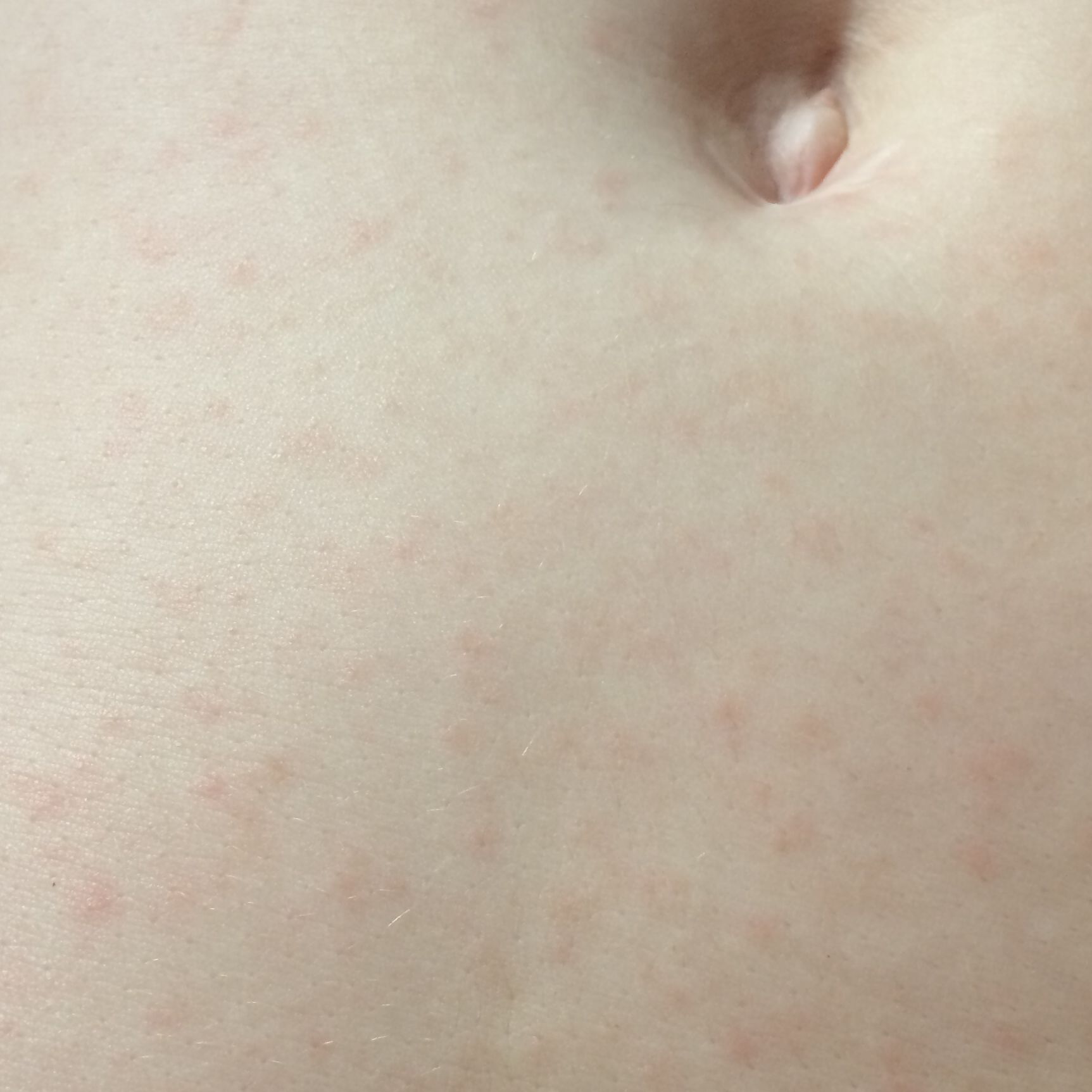 pickel im gesicht und oberkörper pusteln im gesicht durch pressure