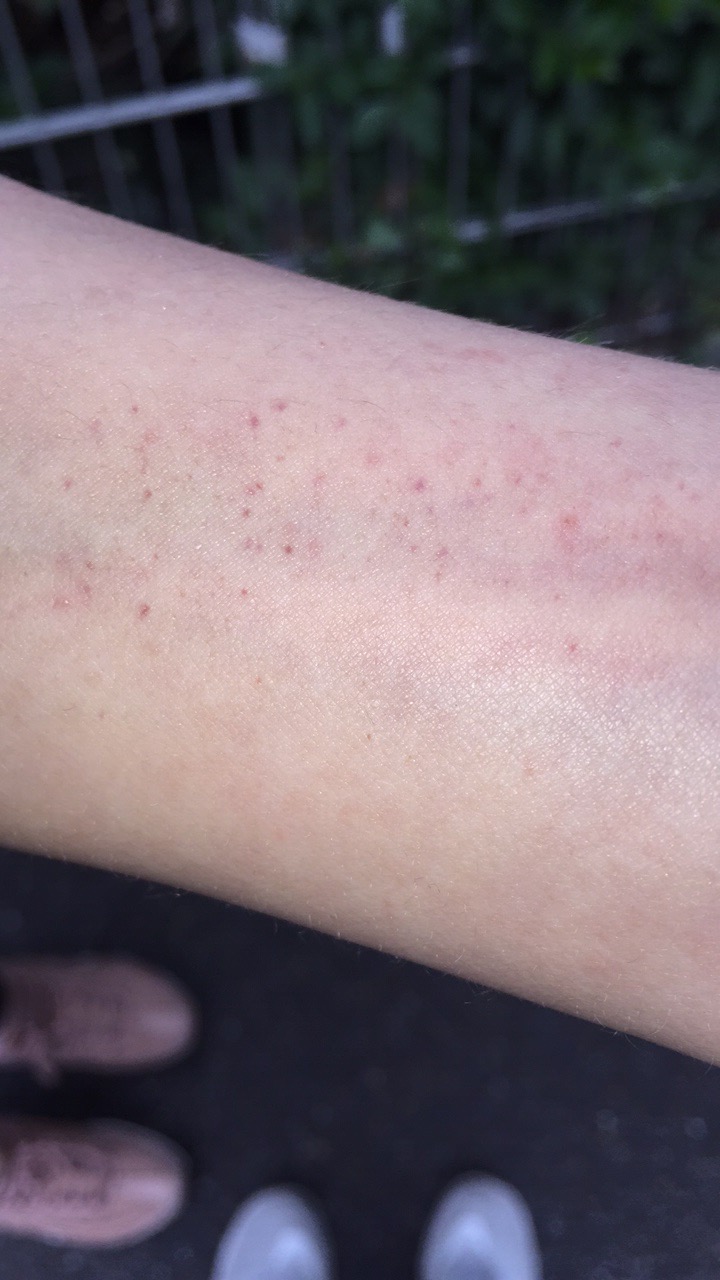 Nochmal ein Bild zur Krätze ? (Gesundheit)