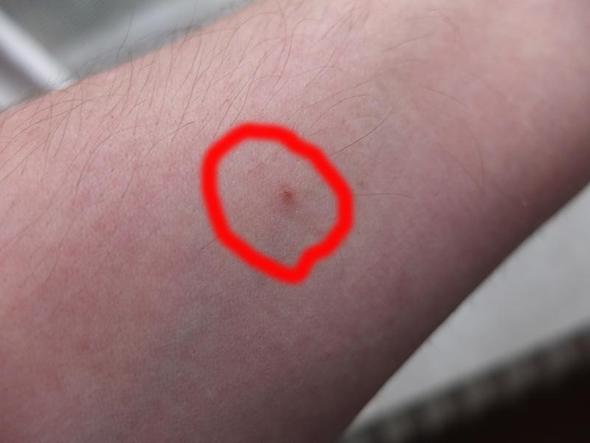 Nochmal Zum Thema Bett Stiche Ungeziefer Ohrenkneifer Kakerlaken Bettwanzen Kleidermotten