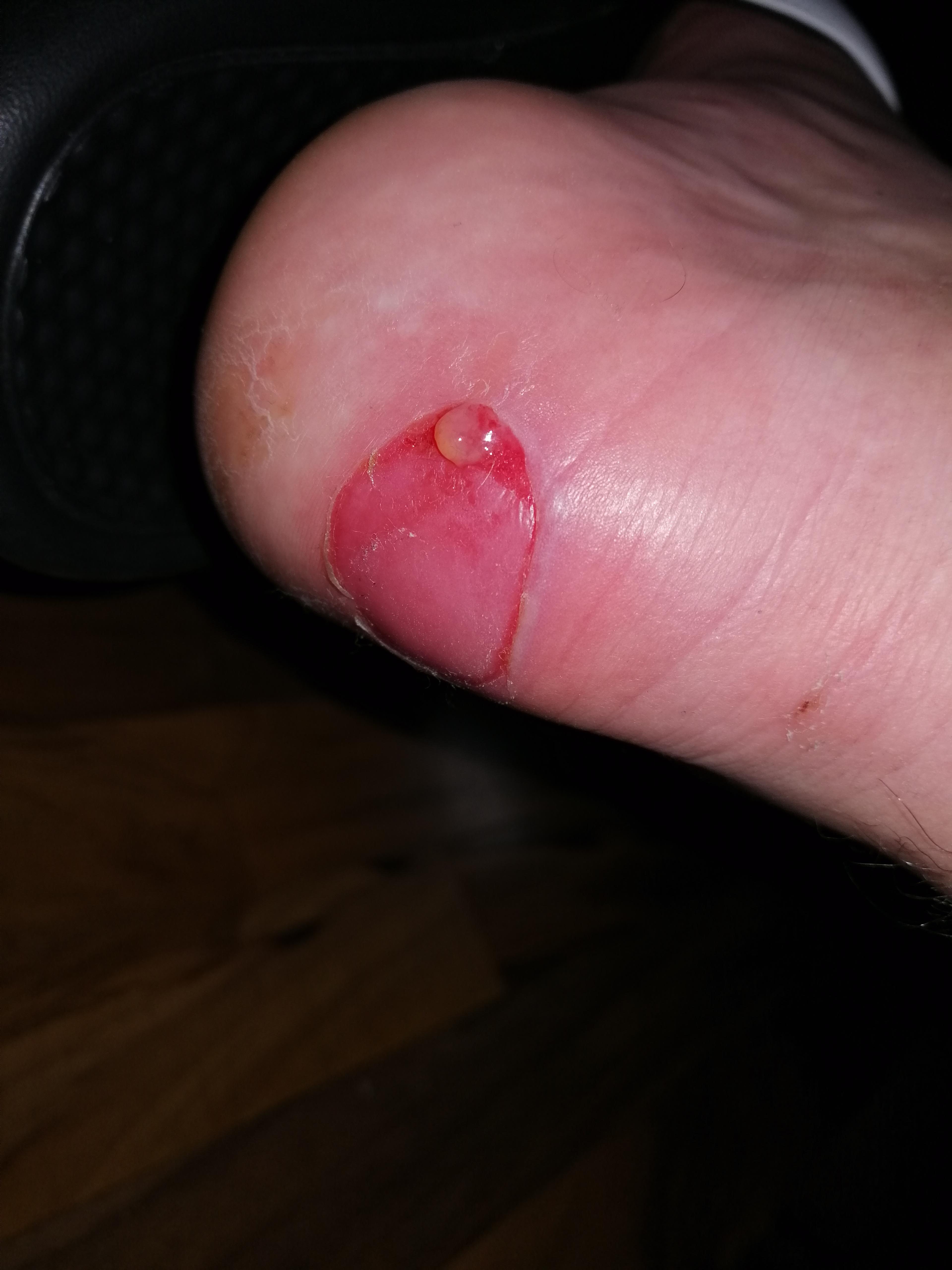 Normal das eine blase so groß ist und wie lange dauert die verheilung