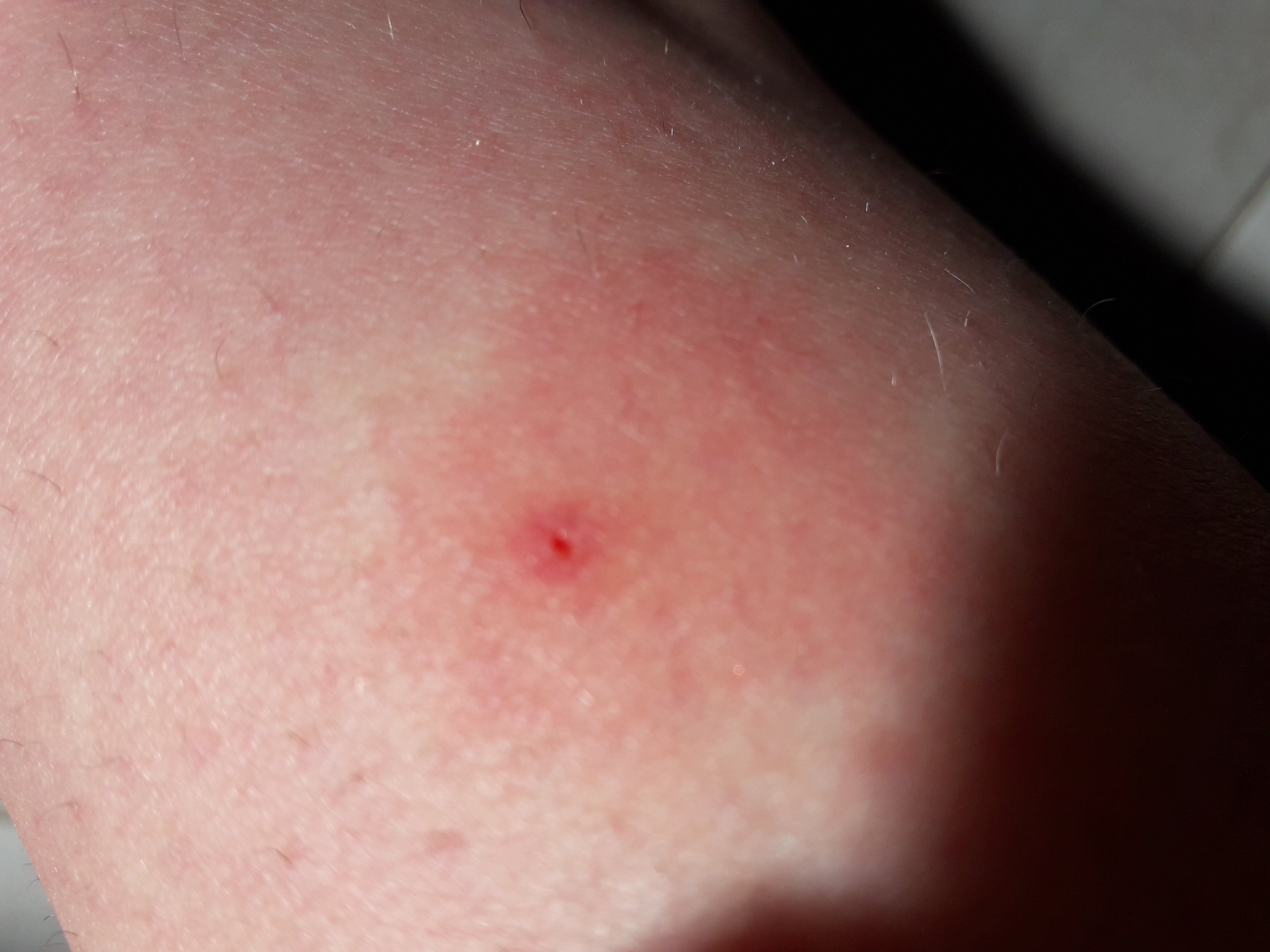 normal das nach einem zeckenbiss die stelle errötet? (Gesundheit