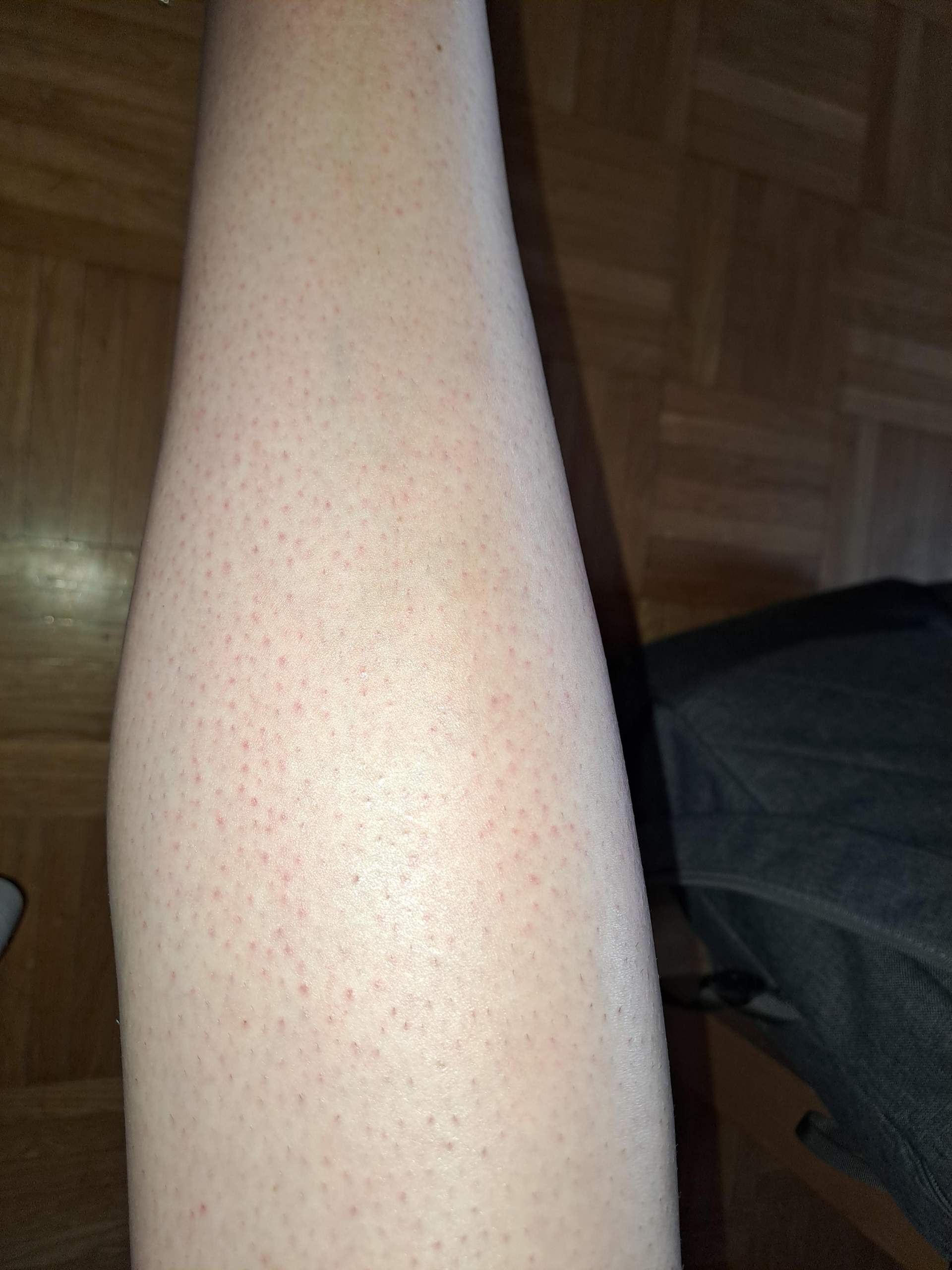 normal nach dem ersten Mal Epilieren? (Gesundheit, Mädchen, Frauen)