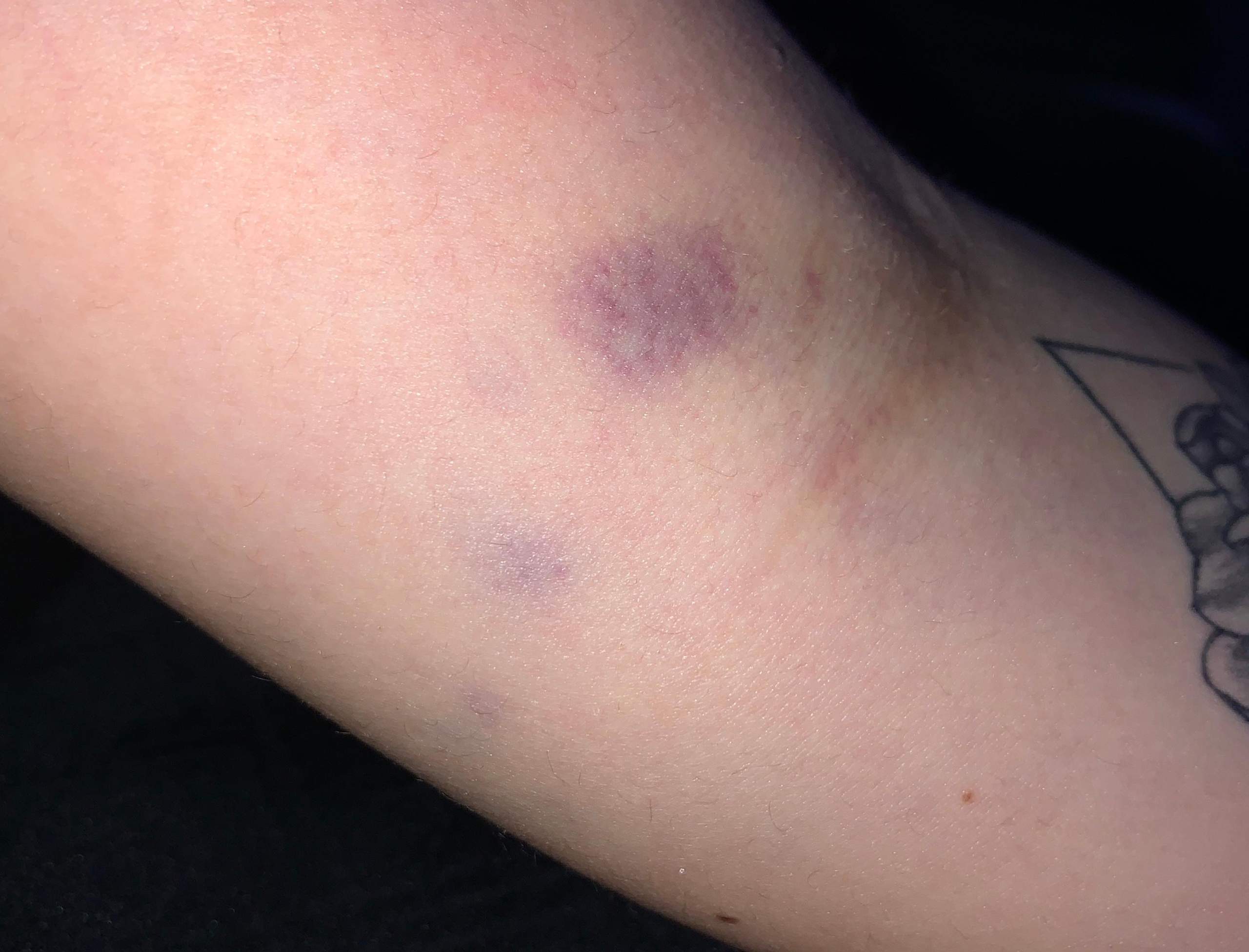 Venenentzündung Im Arm Nach Infusion