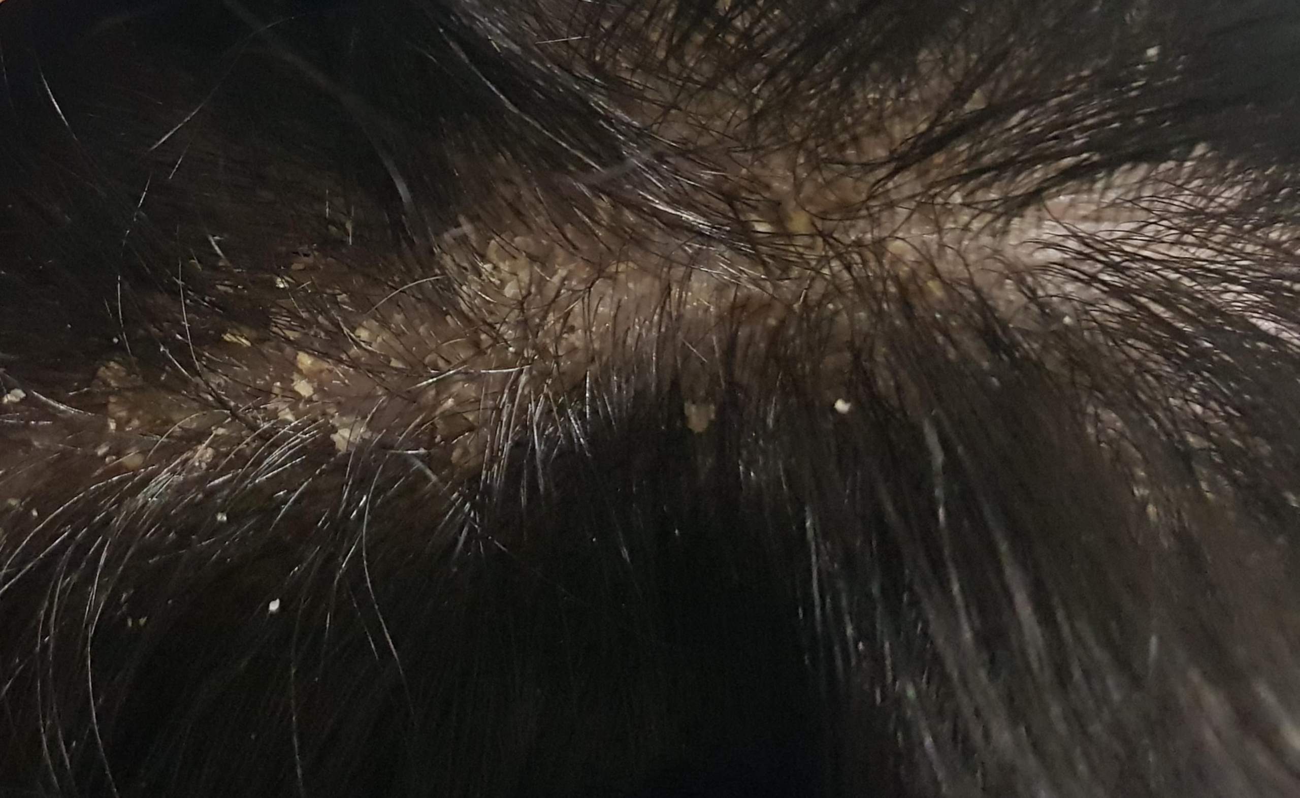 Normale Schuppen? (Gesundheit und Medizin, Medizin, Haare)