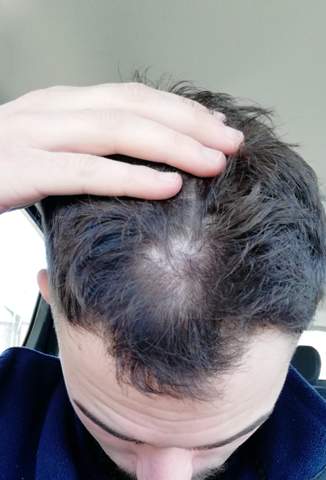 Normaler Scheitel Wirbel Haarausfall Gesundheit Und Medizin Angst Friseur