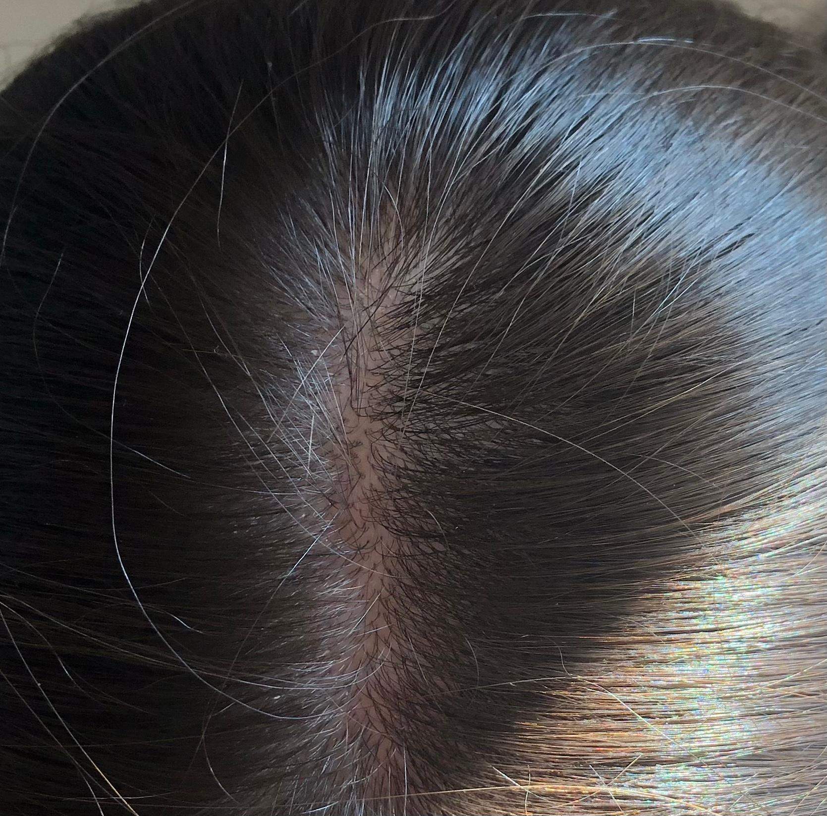 Normaler Scheitel Haare Haarausfall Haaransatz Normaler Scheitel Haare Haarausfall Haaransatz