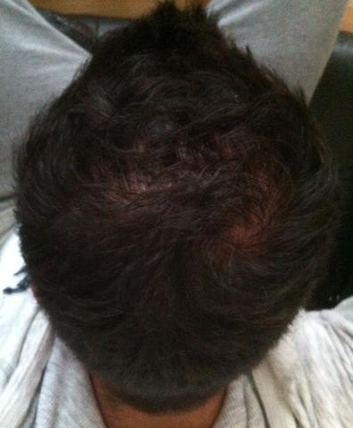 Normaler Wirbel Oder Anzeichen Das Ich Keine Haare Mehr Am Hinterkopf Haben Werde Bitte Hilft Mir Tonspur