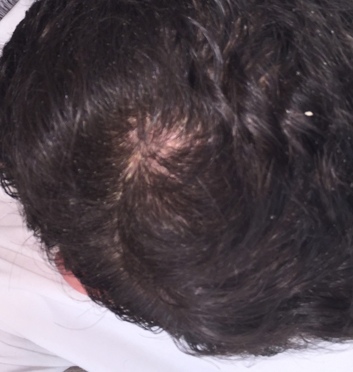 Normaler Wirbel Oder Haarausfall Haare