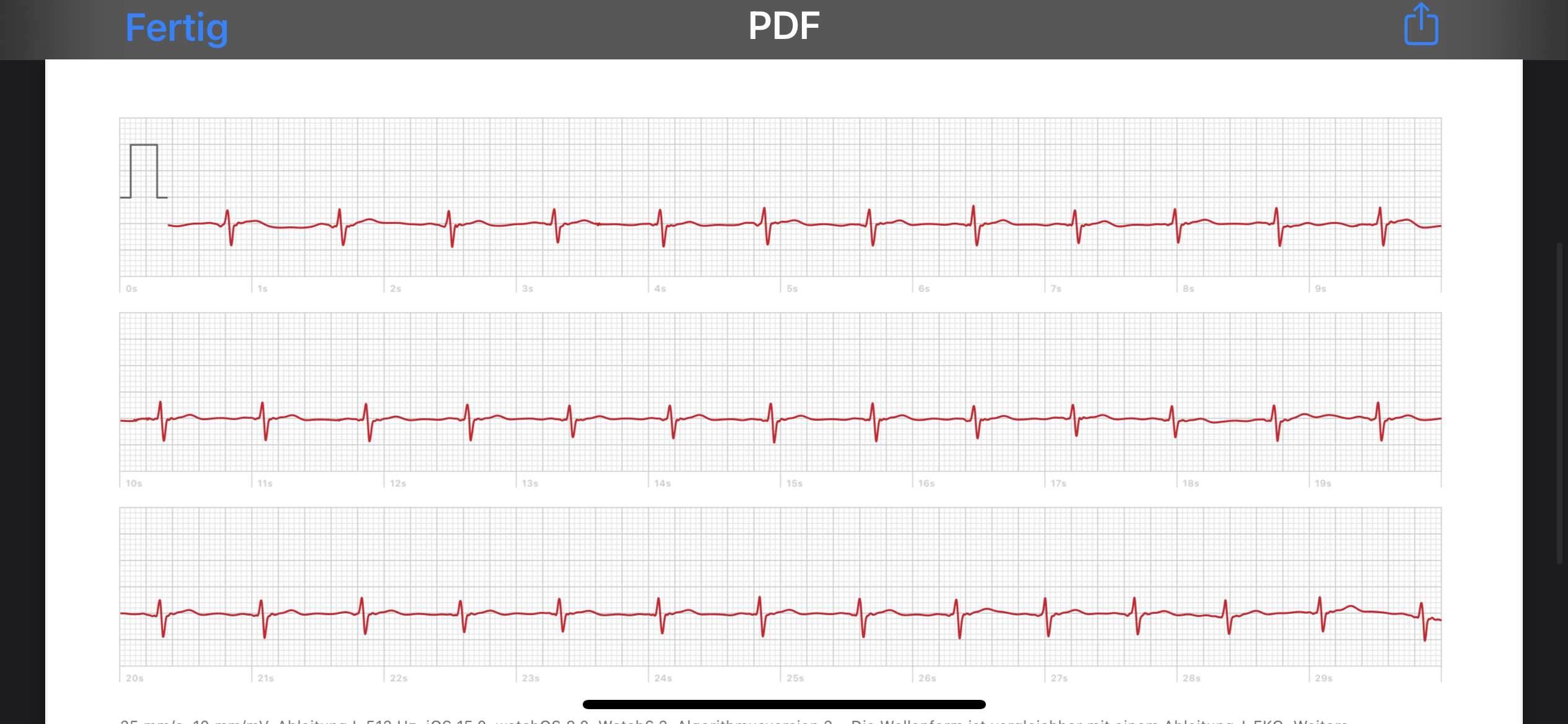 Normales Ekg? (Gesundheit und Medizin, Herz)