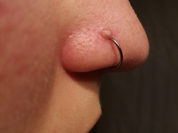 Eiterpickel; piercing Sitzt zu weit vorne? - (Gesundheit und Medizin, Piercing, Eiterpickel)