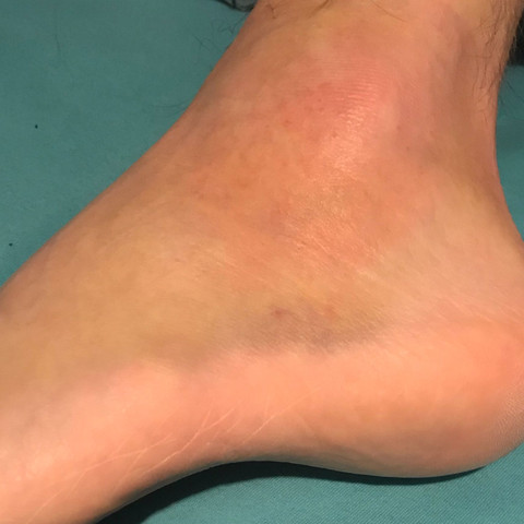 Fuß der betroffen ist  - (Gesundheit und Medizin, Füße, Band)