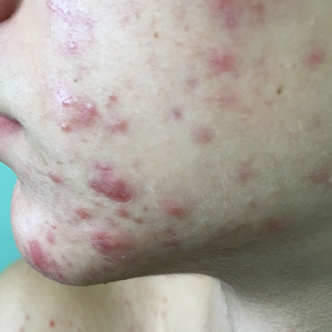 Nur Noch Rotungen Von Pickel Haut Pubertat Gesicht