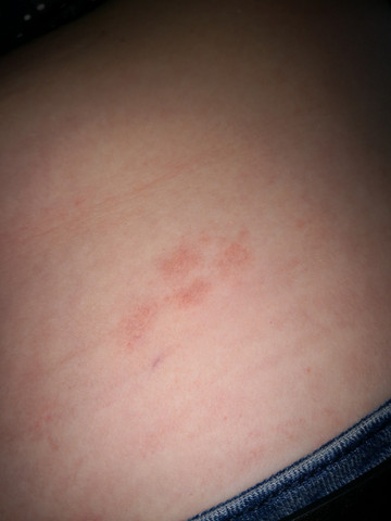 Nur Trockene Haut Hautprobleme Nur Trockene Haut Hautprobleme