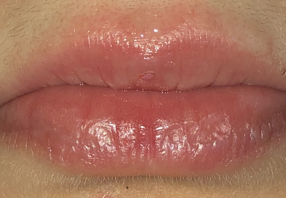 Lippen um roter rand Mundwinkelrhagaden: Ursachen,