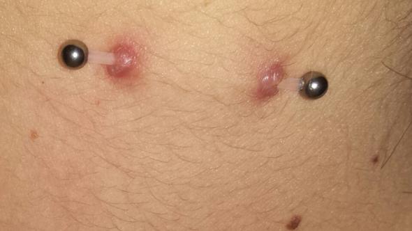 Oberflächenpiercing Nacken (Piercing)