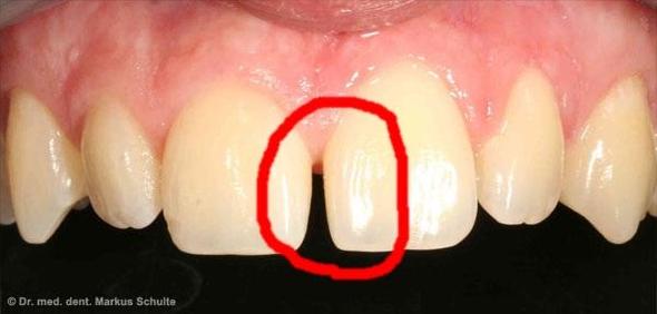 ähnliche zahnlücke - (Schmerzen, Zähne, Zahnarzt)