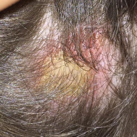 Innere Schamlippe Pickel Eiter Pickel An Der Schamlippe 2020 02 04 Innere Schamlippe Pickel Eiter Pickel An Der Schamlippe 2020 02 04