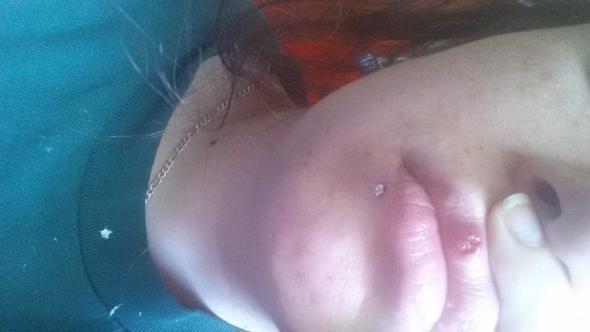 Offene Wunde An Der Lippe Arzt Gesicht Mund