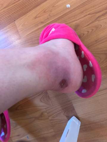 Offene Wunde An Fussen Gesundheit Und Medizin Wundheilungsstorung