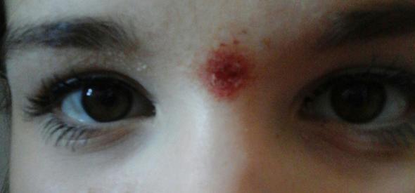 Offener Pickel auf der Stirn - was kann ich daegen tun? (Blut ... Offener Pickel auf der Stirn - was kann ich daegen tun? (Blut ...